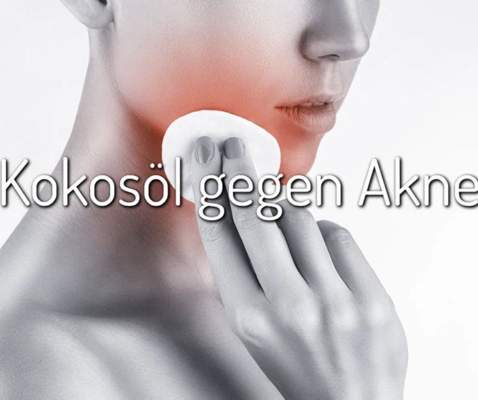Kokosöl gegen Akne
