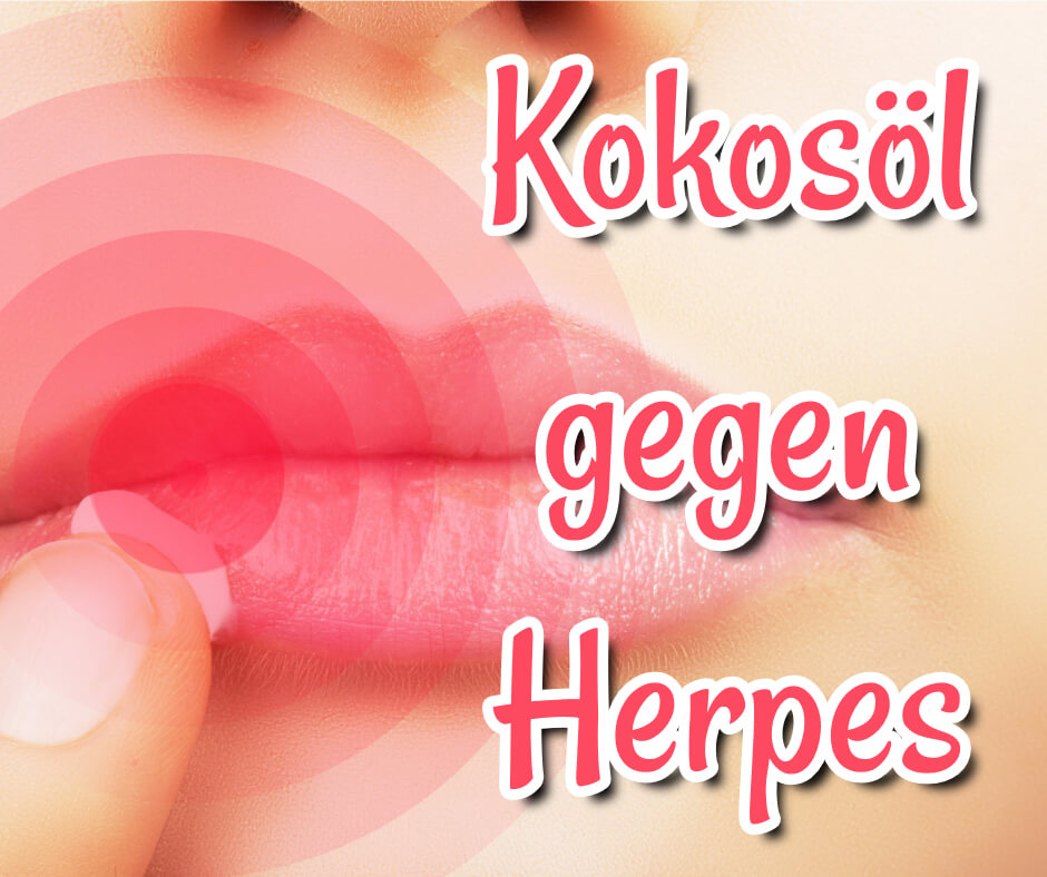 Kokosöl gegen Herpes